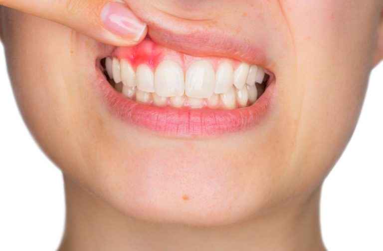 5 Signs of Unhealthy Gums