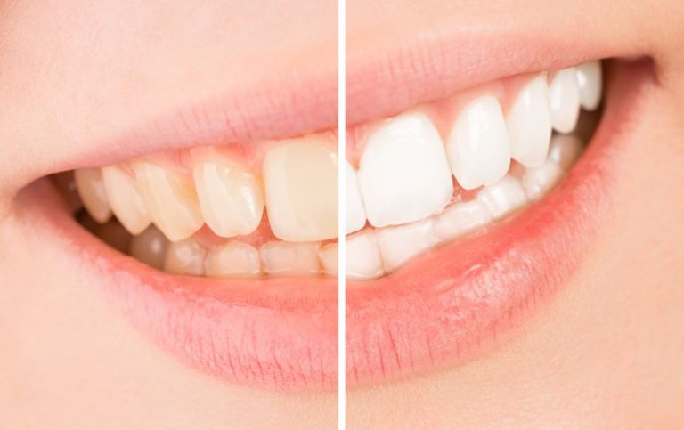 What to Expect During Teeth Whitening Treatments